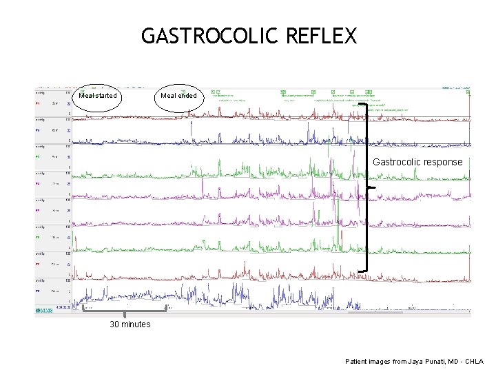 GASTROCOLIC REFLEX Meal started Meal ended Gastrocolic response 30 minutes Patient images from Jaya