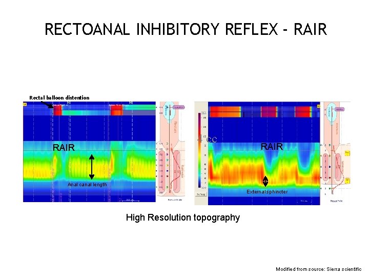 RECTOANAL INHIBITORY REFLEX - RAIR Rectal balloon distention RAIR 4 cc RAIR Anal canal