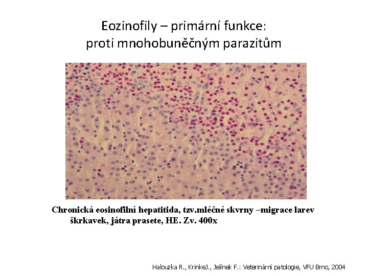 Eozinofily – primární funkce: proti mnohobuněčným parazitům Chronická eosinofilní hepatitida, tzv. mléčné skvrny –migrace