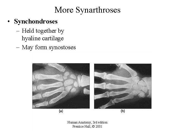 More Synarthroses • Synchondroses – Held together by hyaline cartilage – May form synostoses