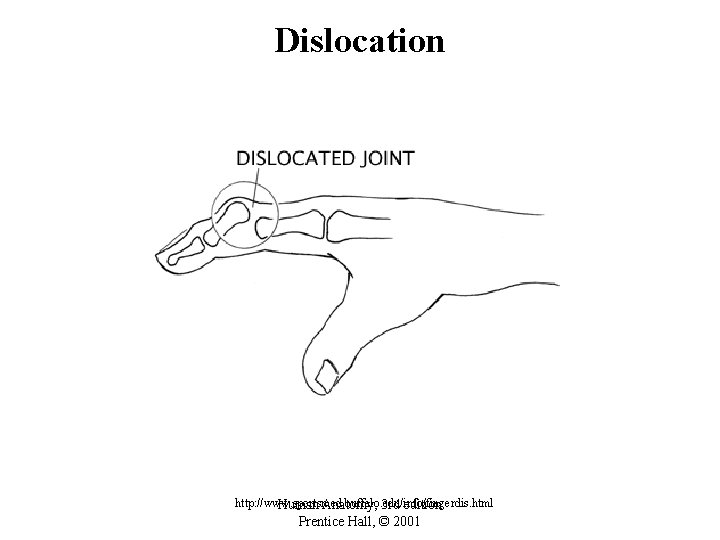 Dislocation http: //www. sportsmed. buffalo. edu/info/fingerdis. html Human Anatomy, 3 rd edition Prentice Hall,