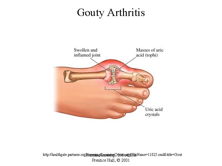 Gouty Arthritis http: //healthgate. partners. org/browsing/Learning. Center. asp? file. Name=11825. xml&title=Gout Human Anatomy, 3