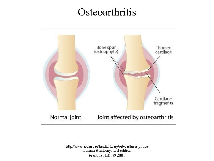 Osteoarthritis http: //www. abc. net. au/health/library/osteoarthritis_ff. htm Human Anatomy, 3 rd edition Prentice Hall,