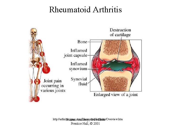 Rheumatoid Arthritis http: //arthritis. upmc. com/Rheumatoid. Arthritis/Overview. htm Human Anatomy, 3 rd edition Prentice