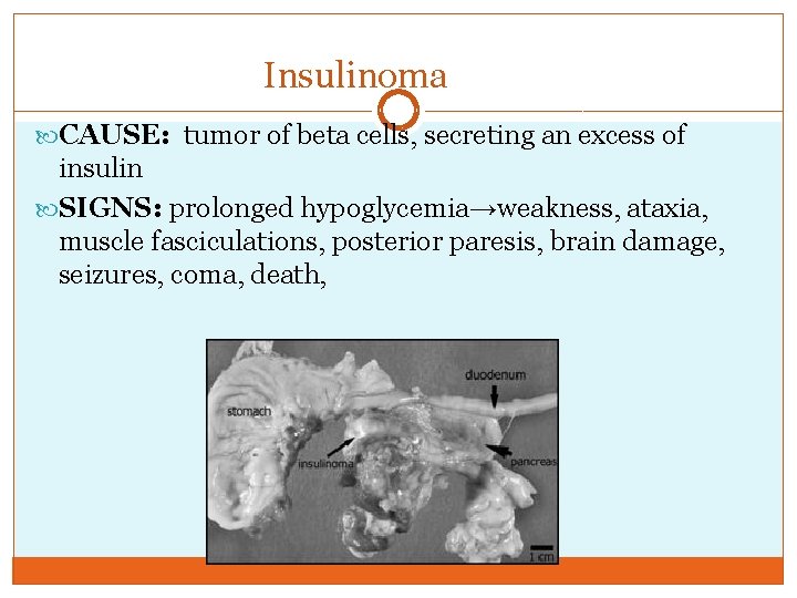 Insulinoma CAUSE: tumor of beta cells, secreting an excess of insulin SIGNS: prolonged hypoglycemia→weakness,