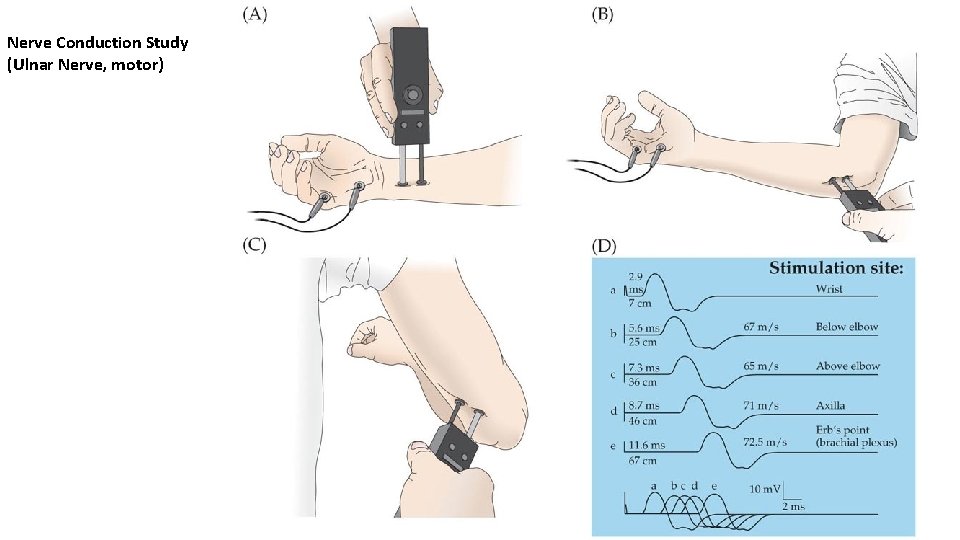 Nerve Conduction Study (Ulnar Nerve, motor) 