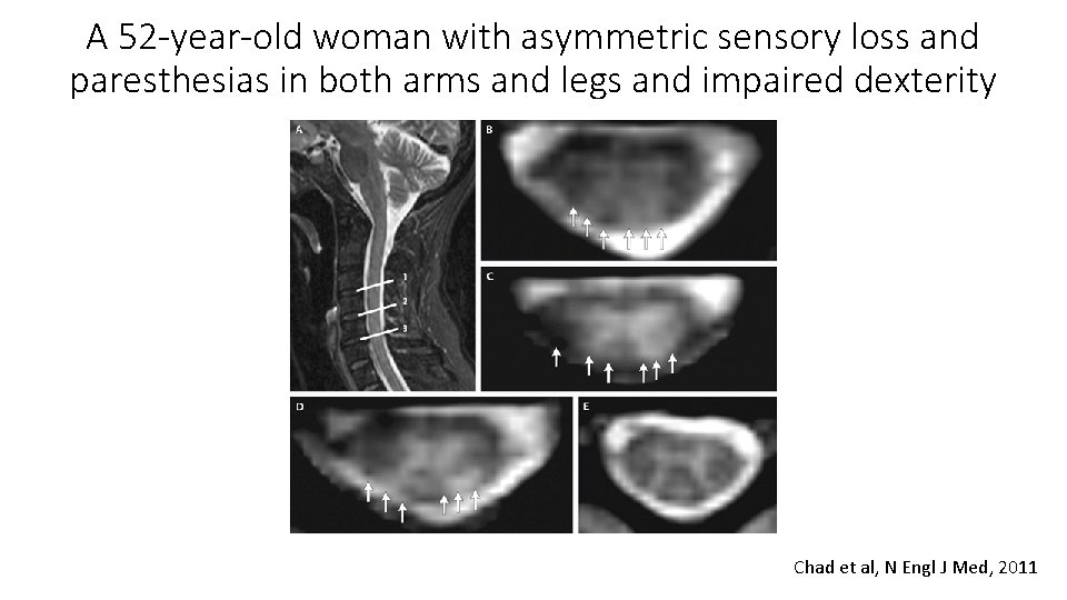 A 52 -year-old woman with asymmetric sensory loss and paresthesias in both arms and