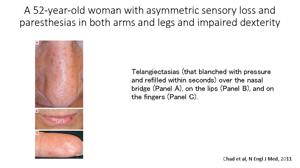 A 52 -year-old woman with asymmetric sensory loss and paresthesias in both arms and