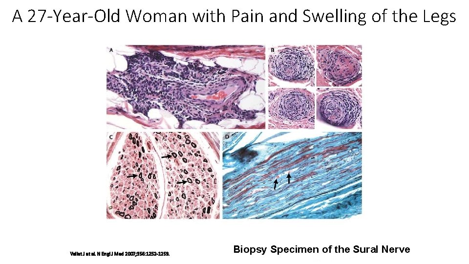 A 27 -Year-Old Woman with Pain and Swelling of the Legs Vallat J et