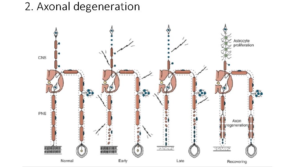 2. Axonal degeneration 