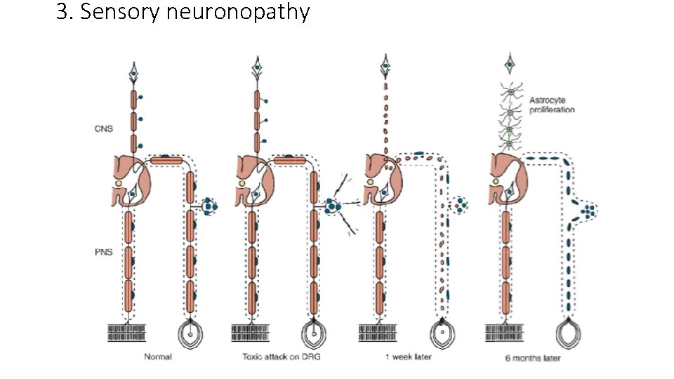 3. Sensory neuronopathy 