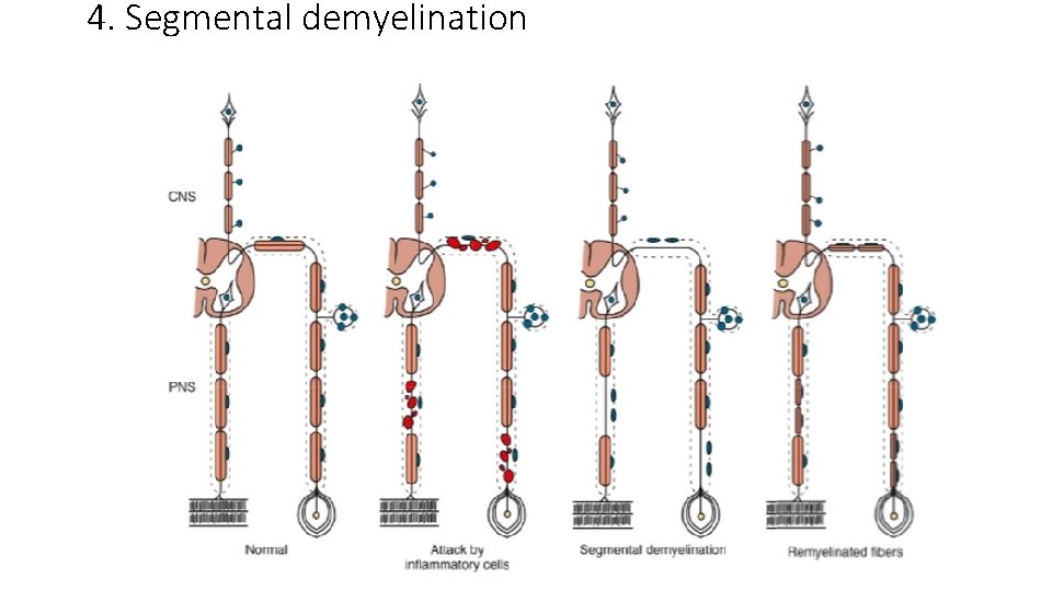 4. Segmental demyelination 