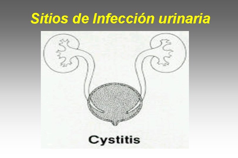 Sitios de Infección urinaria 