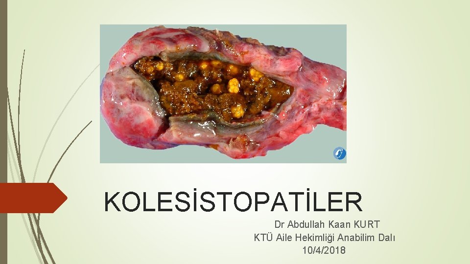 KOLESİSTOPATİLER Dr Abdullah Kaan KURT KTÜ Aile Hekimliği Anabilim Dalı 10/4/2018 