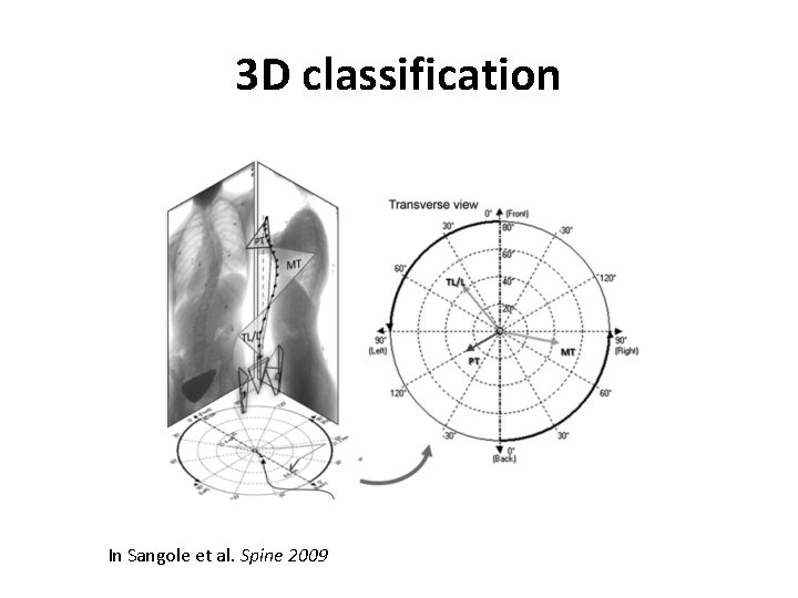 3 D classification In Sangole et al. Spine 2009 