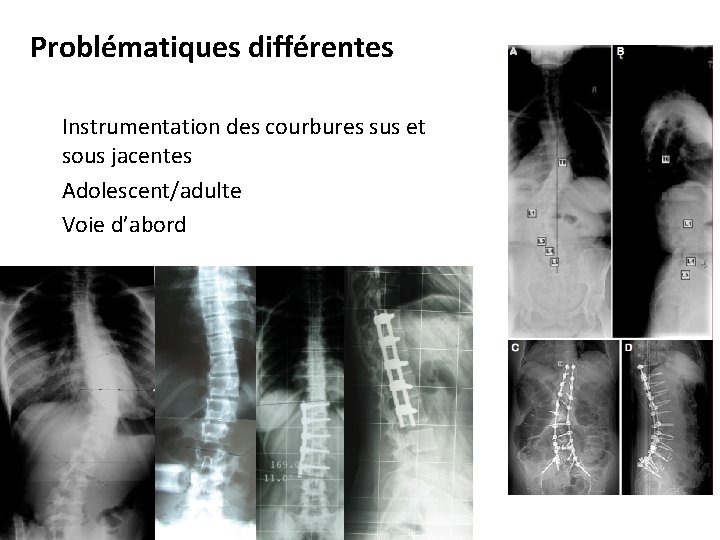 Problématiques différentes Instrumentation des courbures sus et sous jacentes Adolescent/adulte Voie d’abord 