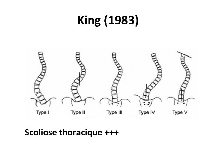 King (1983) Scoliose thoracique +++ 