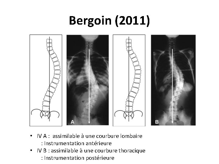 Bergoin (2011) • IV A : assimilable à une courbure lombaire : Instrumentation antérieure