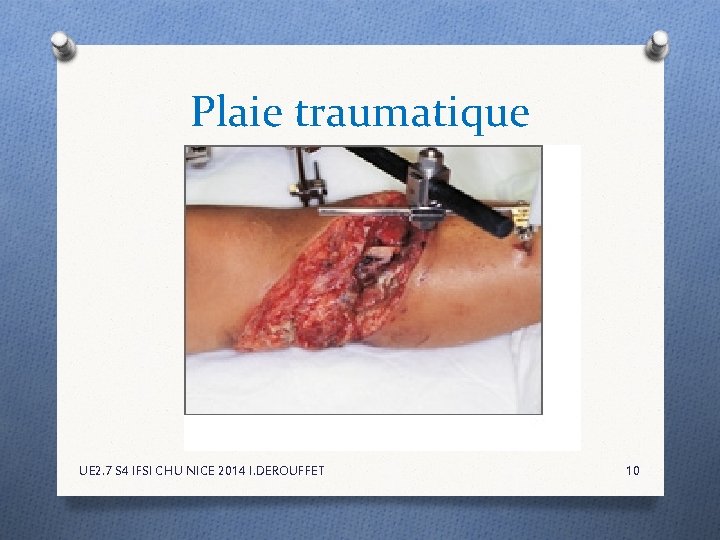 Plaie traumatique UE 2. 7 S 4 IFSI CHU NICE 2014 I. DEROUFFET 10 Plaie traumatique UE 2. 7 S 4 IFSI CHU NICE 2014 I. DEROUFFET 10