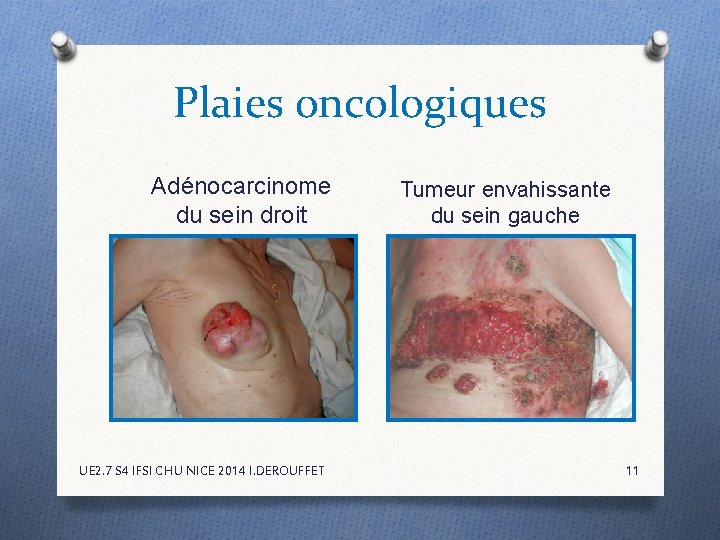Plaies oncologiques Adénocarcinome du sein droit UE 2. 7 S 4 IFSI CHU NICE Plaies oncologiques Adénocarcinome du sein droit UE 2. 7 S 4 IFSI CHU NICE