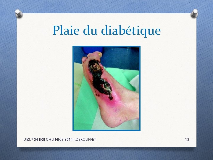 Plaie du diabétique UE 2. 7 S 4 IFSI CHU NICE 2014 I. DEROUFFET Plaie du diabétique UE 2. 7 S 4 IFSI CHU NICE 2014 I. DEROUFFET