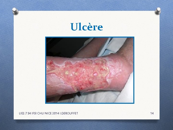 Ulcère UE 2. 7 S 4 IFSI CHU NICE 2014 I. DEROUFFET 14 Ulcère UE 2. 7 S 4 IFSI CHU NICE 2014 I. DEROUFFET 14