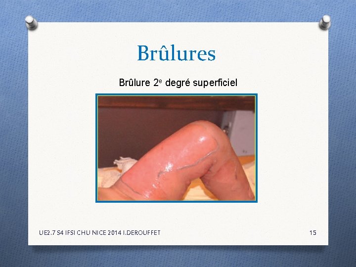 Brûlures Brûlure 2 e degré superficiel UE 2. 7 S 4 IFSI CHU NICE Brûlures Brûlure 2 e degré superficiel UE 2. 7 S 4 IFSI CHU NICE
