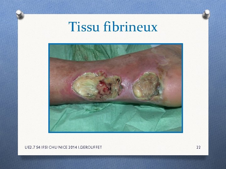 Tissu fibrineux UE 2. 7 S 4 IFSI CHU NICE 2014 I. DEROUFFET 22 Tissu fibrineux UE 2. 7 S 4 IFSI CHU NICE 2014 I. DEROUFFET 22
