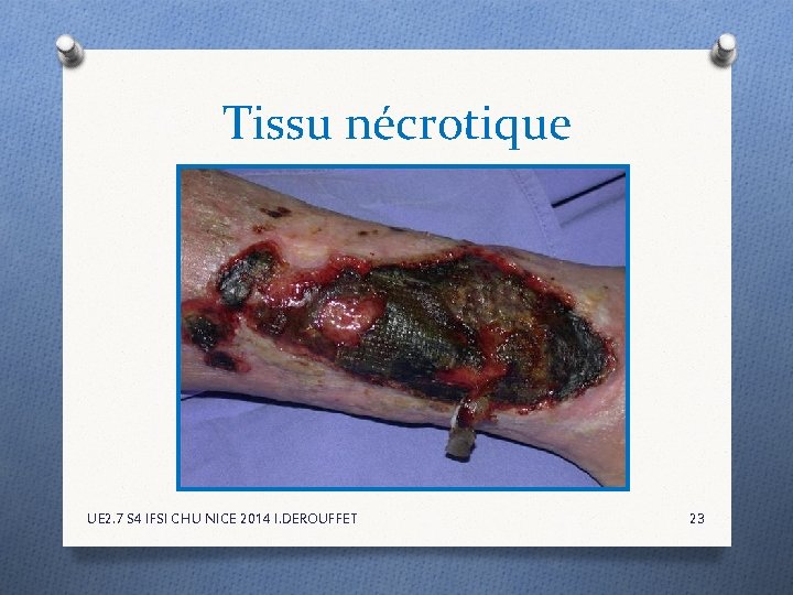 Tissu nécrotique UE 2. 7 S 4 IFSI CHU NICE 2014 I. DEROUFFET 23 Tissu nécrotique UE 2. 7 S 4 IFSI CHU NICE 2014 I. DEROUFFET 23