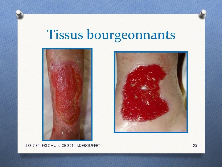 Tissus bourgeonnants UE 2. 7 S 4 IFSI CHU NICE 2014 I. DEROUFFET 25 Tissus bourgeonnants UE 2. 7 S 4 IFSI CHU NICE 2014 I. DEROUFFET 25