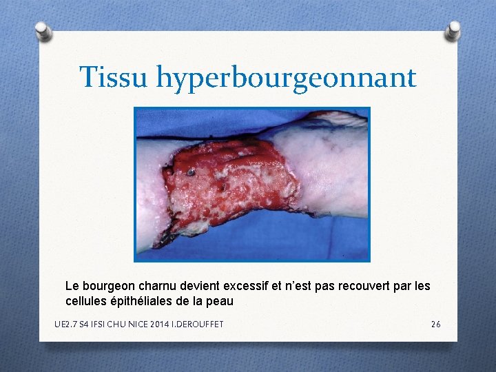 Tissu hyperbourgeonnant Le bourgeon charnu devient excessif et n’est pas recouvert par les cellules Tissu hyperbourgeonnant Le bourgeon charnu devient excessif et n’est pas recouvert par les cellules