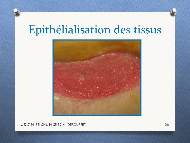 Epithélialisation des tissus UE 2. 7 S 4 IFSI CHU NICE 2014 I. DEROUFFET Epithélialisation des tissus UE 2. 7 S 4 IFSI CHU NICE 2014 I. DEROUFFET