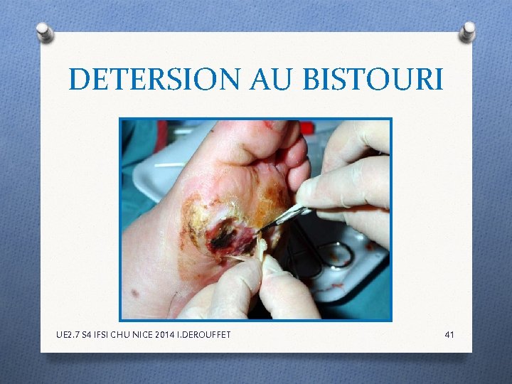 DETERSION AU BISTOURI UE 2. 7 S 4 IFSI CHU NICE 2014 I. DEROUFFET DETERSION AU BISTOURI UE 2. 7 S 4 IFSI CHU NICE 2014 I. DEROUFFET