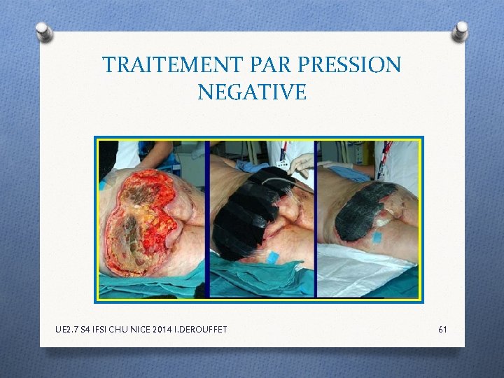 TRAITEMENT PAR PRESSION NEGATIVE UE 2. 7 S 4 IFSI CHU NICE 2014 I. TRAITEMENT PAR PRESSION NEGATIVE UE 2. 7 S 4 IFSI CHU NICE 2014 I.