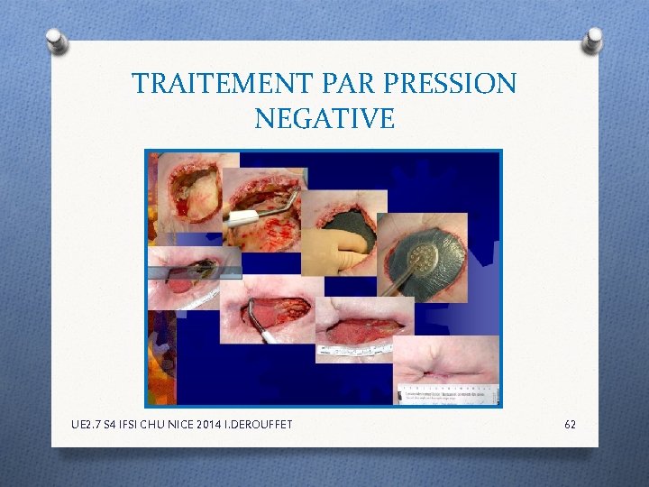 TRAITEMENT PAR PRESSION NEGATIVE UE 2. 7 S 4 IFSI CHU NICE 2014 I. TRAITEMENT PAR PRESSION NEGATIVE UE 2. 7 S 4 IFSI CHU NICE 2014 I.