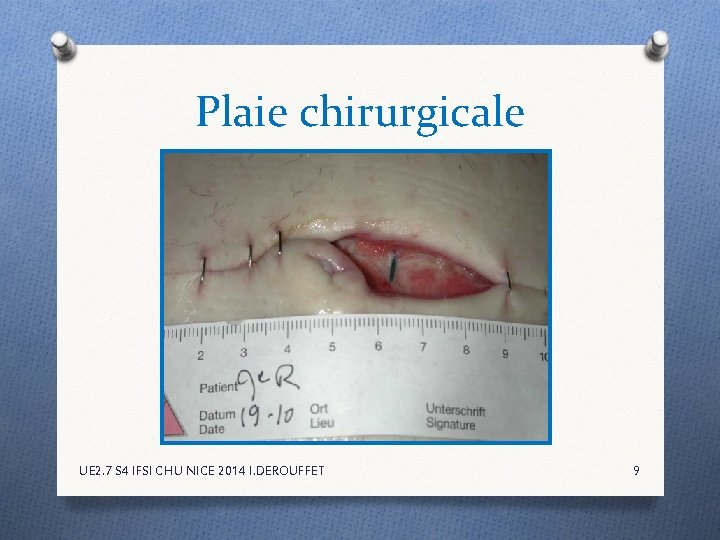 Plaie chirurgicale UE 2. 7 S 4 IFSI CHU NICE 2014 I. DEROUFFET 9 Plaie chirurgicale UE 2. 7 S 4 IFSI CHU NICE 2014 I. DEROUFFET 9