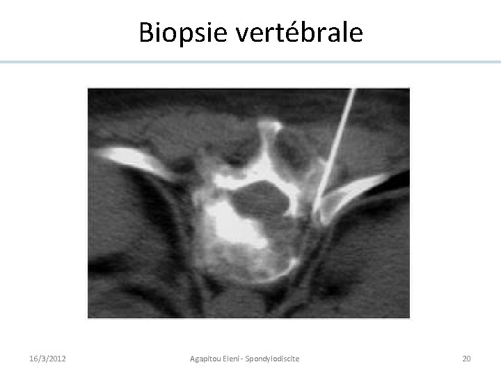 Biopsie vertébrale 16/3/2012 Agapitou Eleni - Spondylodiscite 20 