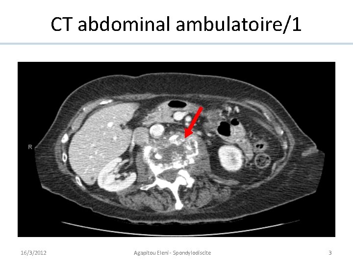 CT abdominal ambulatoire/1 16/3/2012 Agapitou Eleni - Spondylodiscite 3 