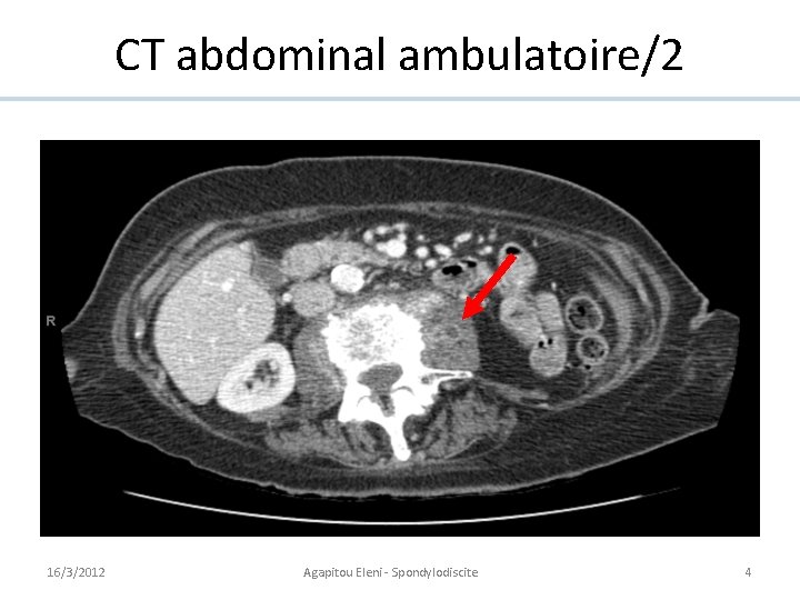 CT abdominal ambulatoire/2 16/3/2012 Agapitou Eleni - Spondylodiscite 4 