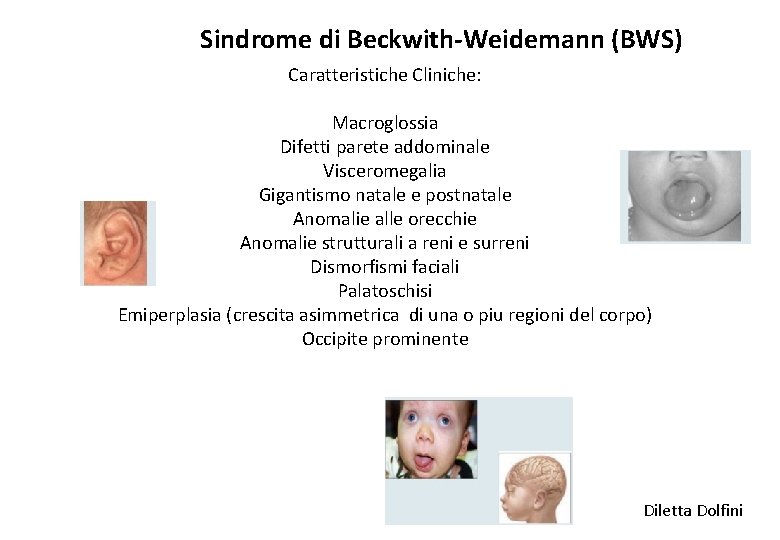 Sindrome di Beckwith-Weidemann (BWS) Caratteristiche Cliniche: Macroglossia Difetti parete addominale Visceromegalia Gigantismo natale e