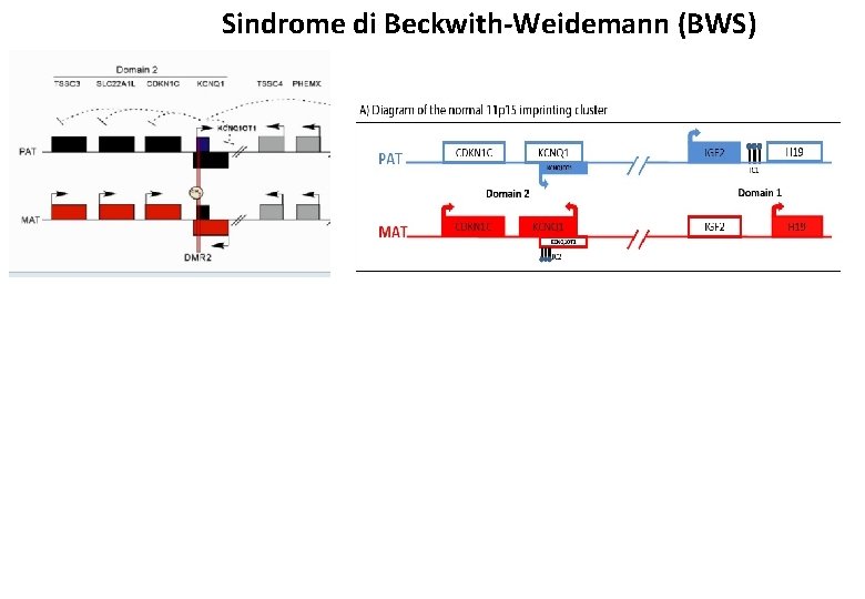 Sindrome di Beckwith-Weidemann (BWS) 