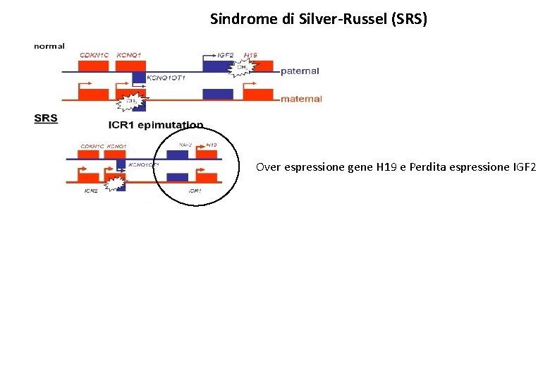 Sindrome di Silver-Russel (SRS) Over espressione gene H 19 e Perdita espressione IGF 2