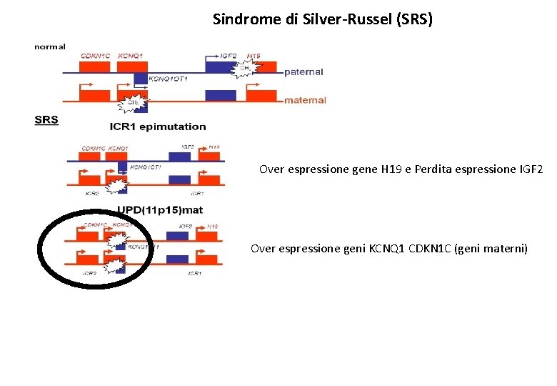 Sindrome di Silver-Russel (SRS) Over espressione gene H 19 e Perdita espressione IGF 2