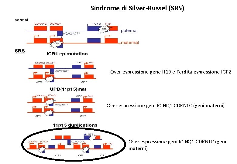 Sindrome di Silver-Russel (SRS) Over espressione gene H 19 e Perdita espressione IGF 2