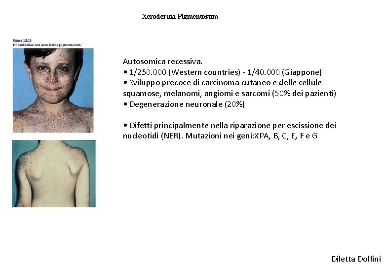 Xeroderma Pigmentosum Autosomica recessiva. • 1/250. 000 (Western countries) - 1/40. 000 (Giappone) •