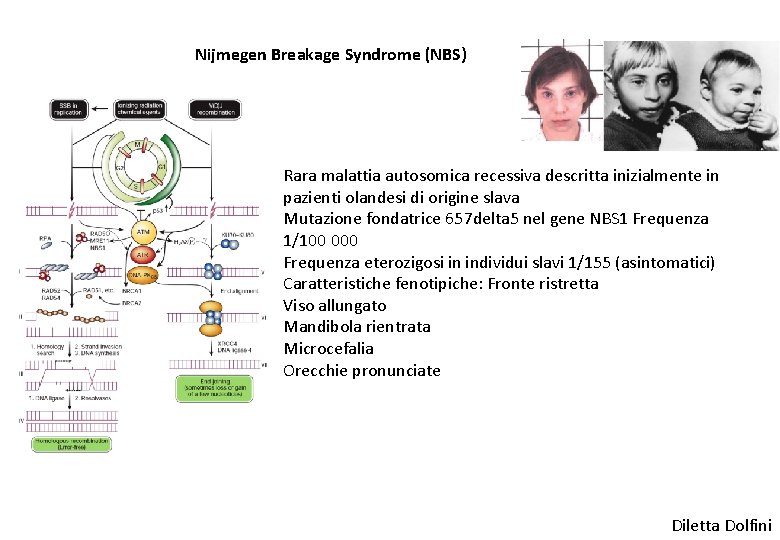 Nijmegen Breakage Syndrome (NBS) Rara malattia autosomica recessiva descritta inizialmente in pazienti olandesi di