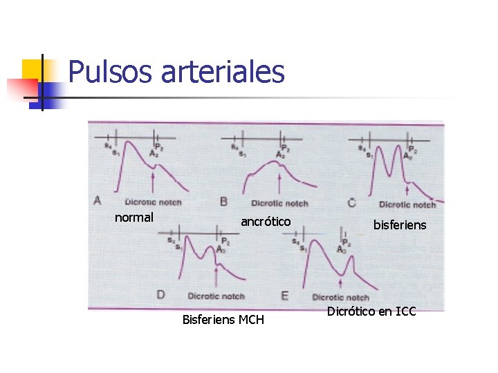 Pulsos arteriales normal ancrótico Bisferiens MCH bisferiens Dicrótico en ICC 