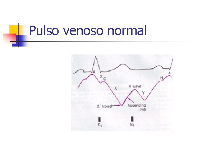 Pulso venoso normal 