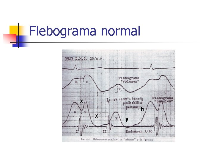 Flebograma normal x h X´ y 