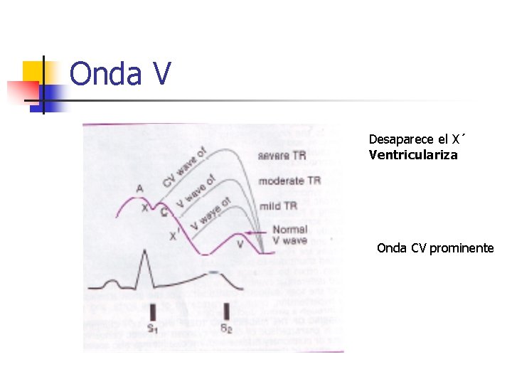 Onda V Desaparece el X´ Ventriculariza Onda CV prominente 